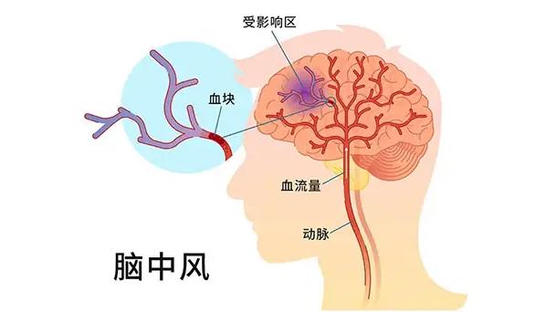 脑梗演示图